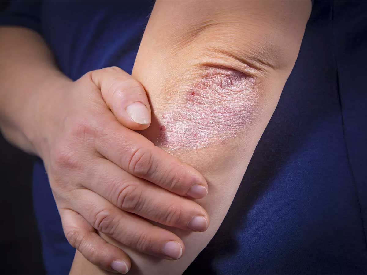psoriasis, colère, Peur de perdre, deuil